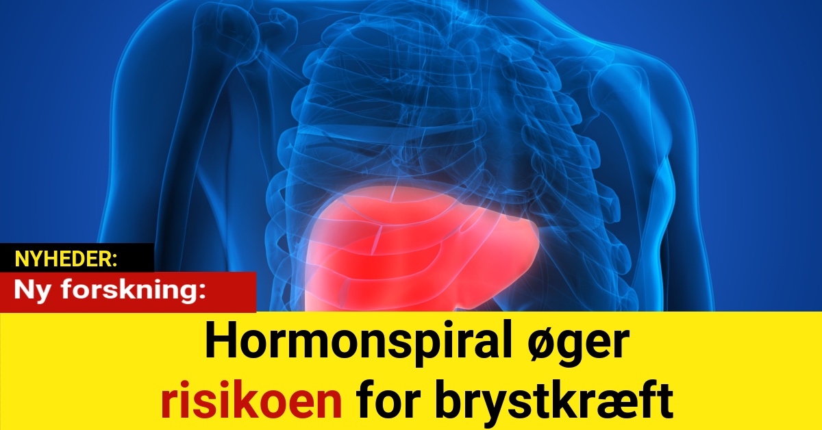 Ny forskning: Hormonspiral øger risikoen for brystkræft