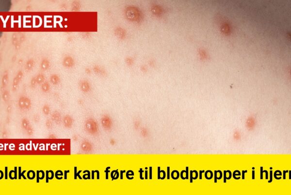 Danske studier: Skoldkopper øger risikoen for blodprop hos små børn