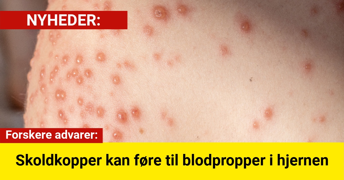 Danske studier: Skoldkopper øger risikoen for blodprop hos små børn